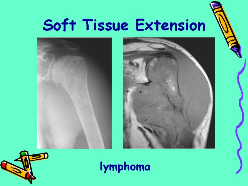 lymphoma Soft Tissue Extension